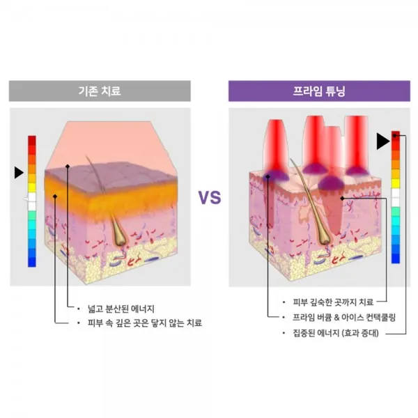 악센트프라임, 유니폴라 고주파 리프팅 — 이미지 3